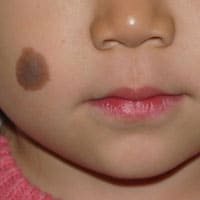 色素性母斑(右頬) 治療後の声