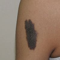 色素性母斑(左上腕) 治療後の声