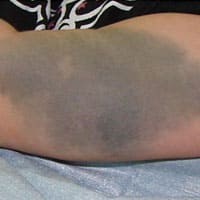 異所性蒙古斑(左上腕) 治療後の声