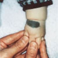 異所性蒙古斑(生後2ヶ月~下腿まで) 治療後の声