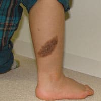 獣皮様母斑切除術(足) 治療後の声