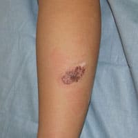 色素性母斑切除術 治療後の声