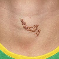 表皮母斑(頚部) 治療後の声